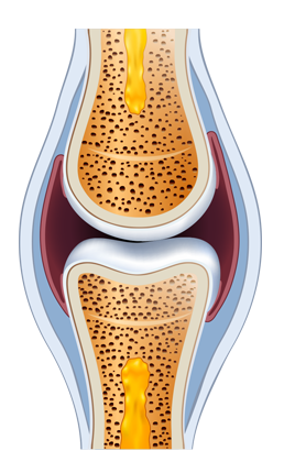 osteoartroza durerii de șold medicația articulației gleznei