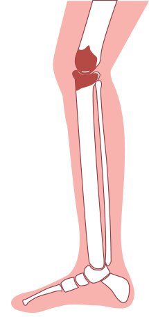 fonația cu artroza articulațiilor