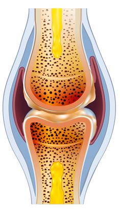 Artroza primei etape a articulației genunchiului